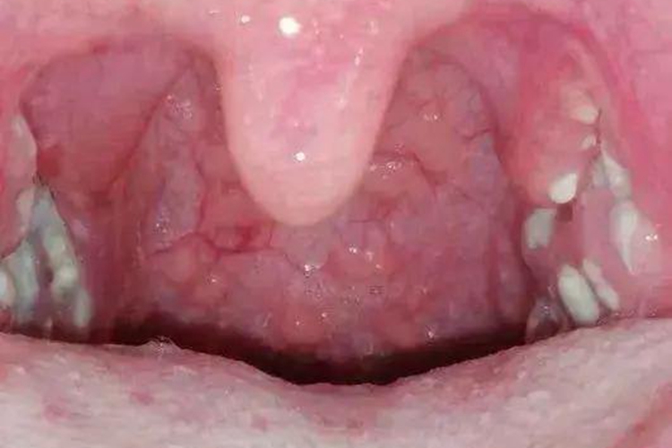 急性扁桃体炎疙瘩图 急性扁桃体炎疙瘩图