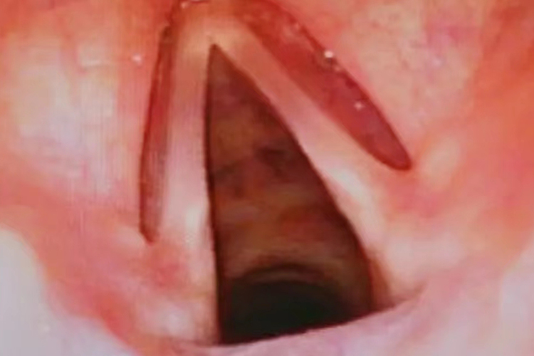 正常喉咙吸气图