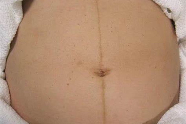 怀孕后腹部色素沉着图