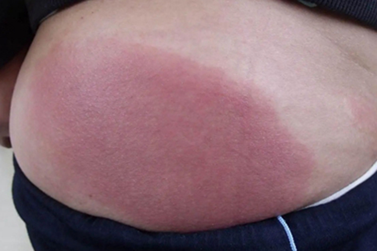 接触性皮炎腹部红斑图 接触性皮炎腹部红斑图