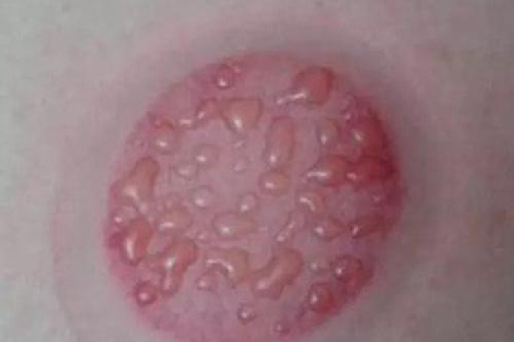 女性背部拔罐后淡红图