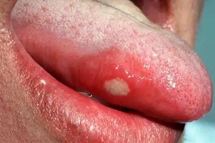 舌头侧边轻型阿弗他溃疡图