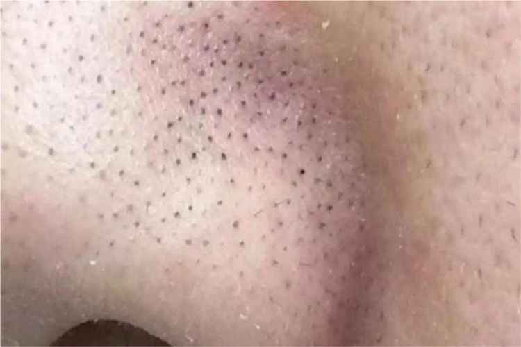 小棘毛壅病鼻部症状图