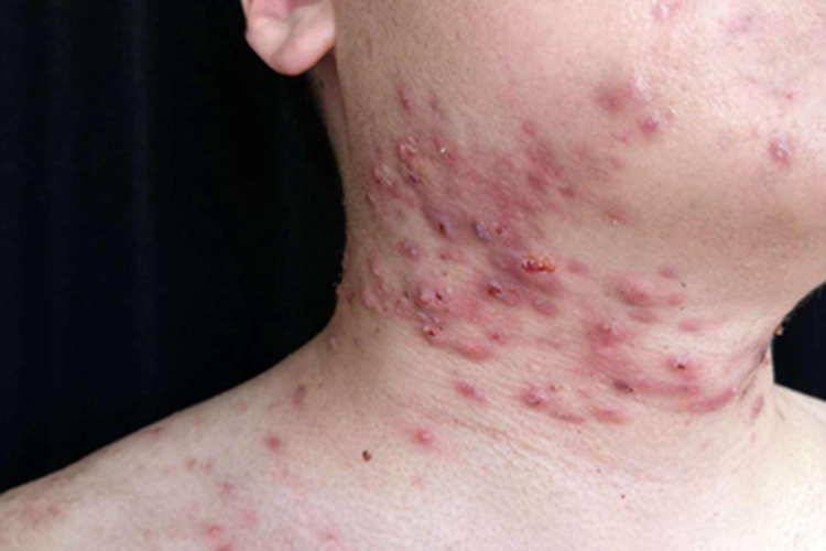 聚合性痤疮侧颈症状图