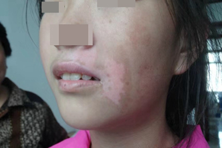 节段型白癜风面部斑图