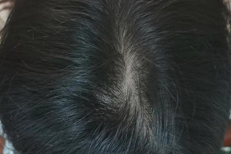 正常人的头发密度图