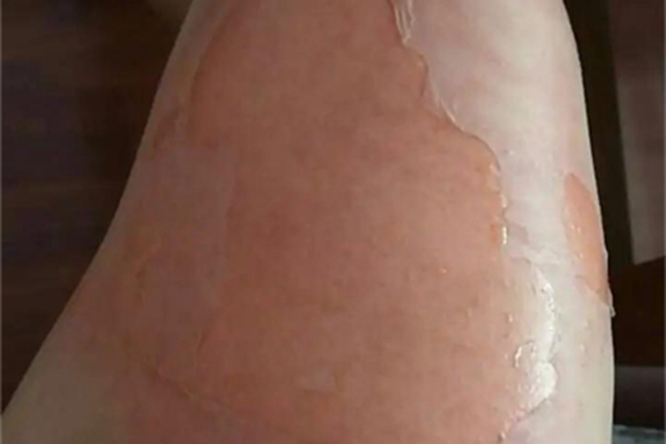 一度烫伤大腿破皮发红图 一度烫伤大腿破皮发红图