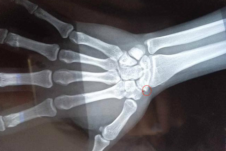 手腕骨刺影像图