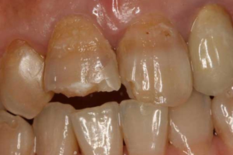 中度四环素牙竖纹图 中度四环素牙竖纹图