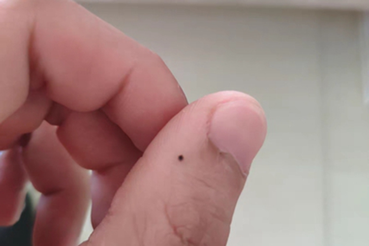 交界痣手指黑痣图