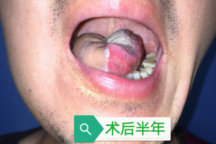 舌癌术后半年皮瓣恢复图