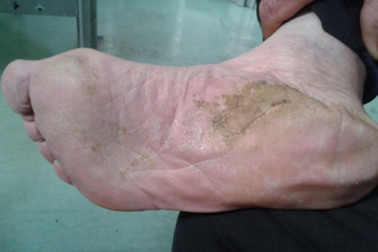 获得性掌跖角化病脚底皮肤增厚图