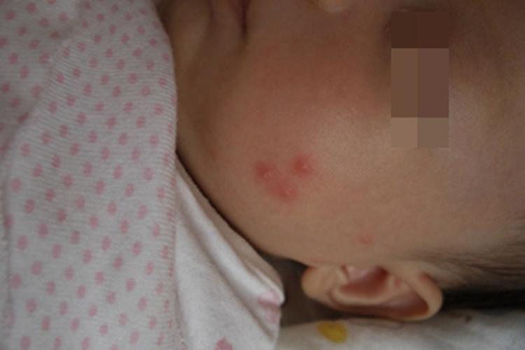 蚊虫叮咬面部小红疙瘩图