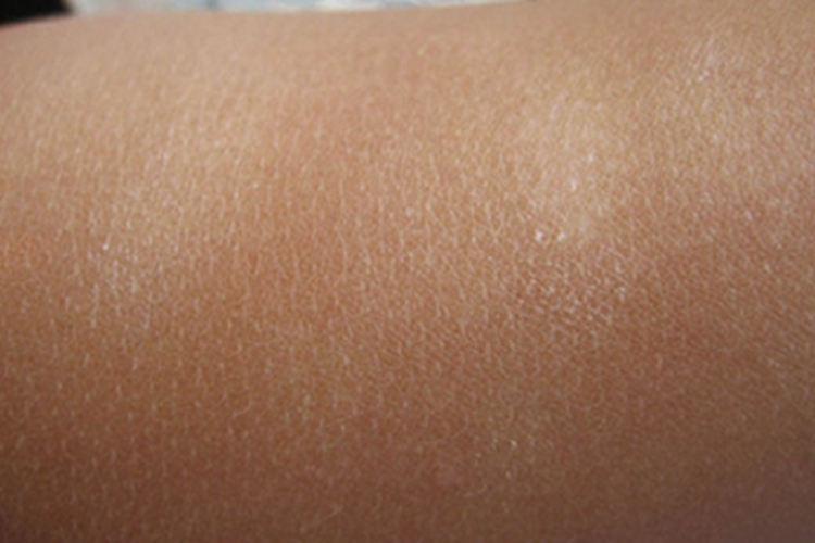 白色糠疹胳膊上长斑图