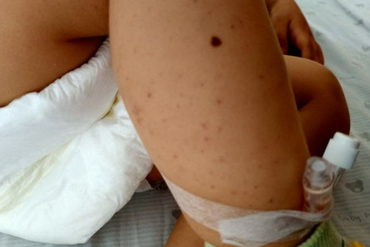 婴儿免疫性血小板减少症症状图 婴儿免疫性血小板减少症症状图