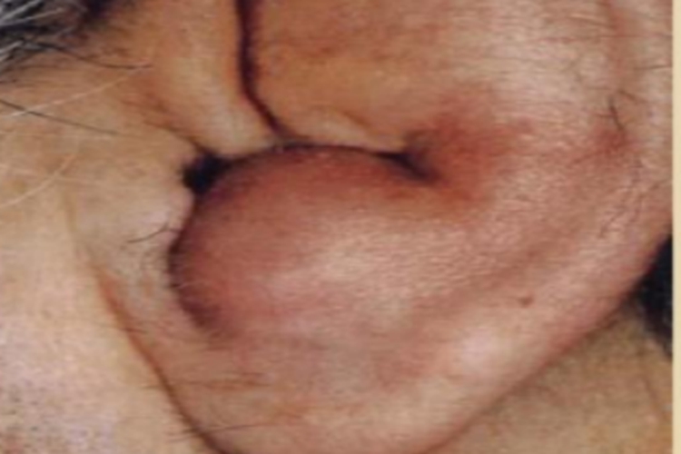 耳廓假囊肿包块图 耳廓假囊肿包块图