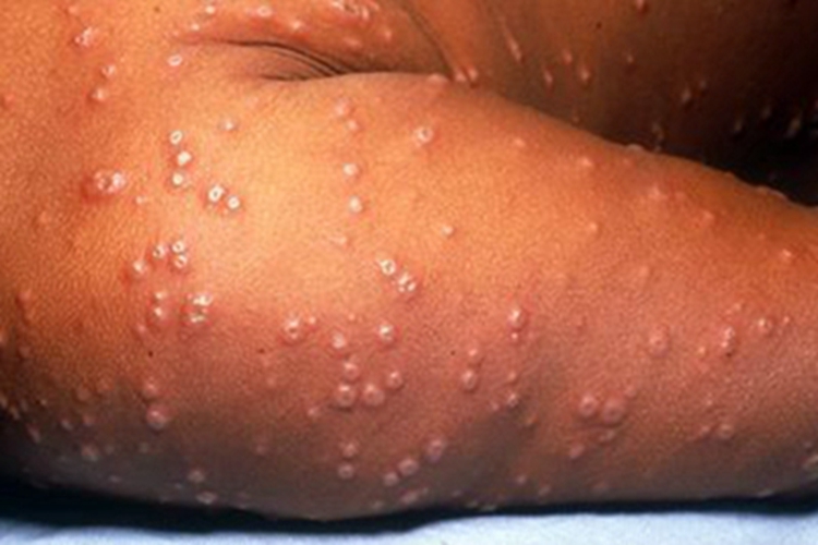 天花水疱图 天花水疱图