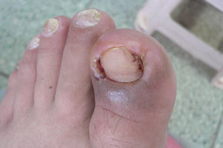 急性甲沟炎皮肤发黑图 急性甲沟炎皮肤发黑图