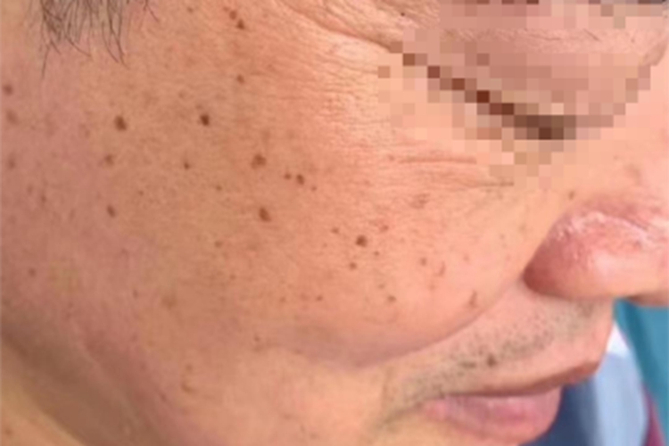 脂溢性角化病面部斑图