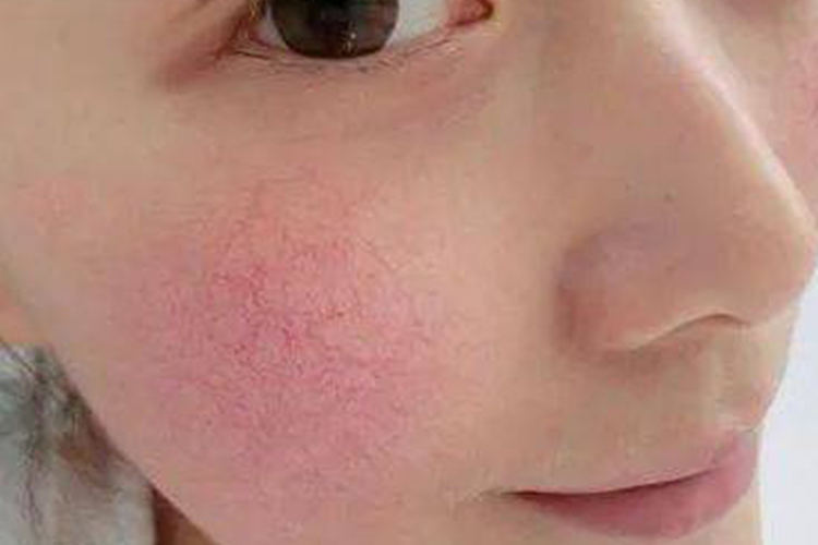 面部毛细血管破裂扩张图 面部毛细血管破裂扩张图