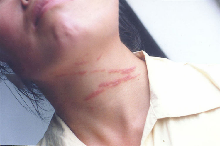 隐翅虫咬人条索状红肿图