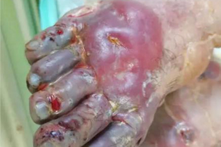 Ⅲ度冻伤症状图