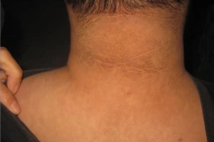 融合性网状乳头瘤病斑图