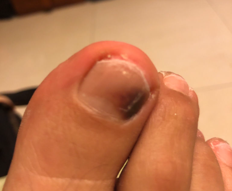 甲下淤血大脚趾边缘一侧发黑图 甲下淤血大脚趾边缘一侧发黑图