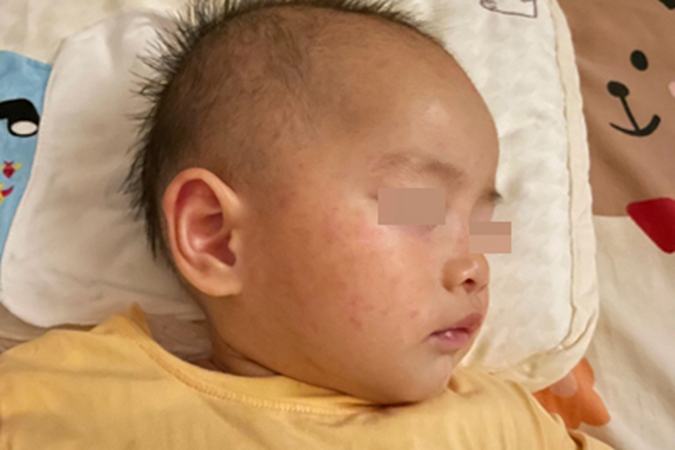 幼儿急疹面部丘疹图