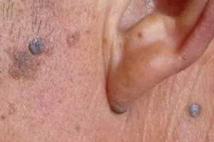 脂溢性角化病皮疹图 脂溢性角化病皮疹图