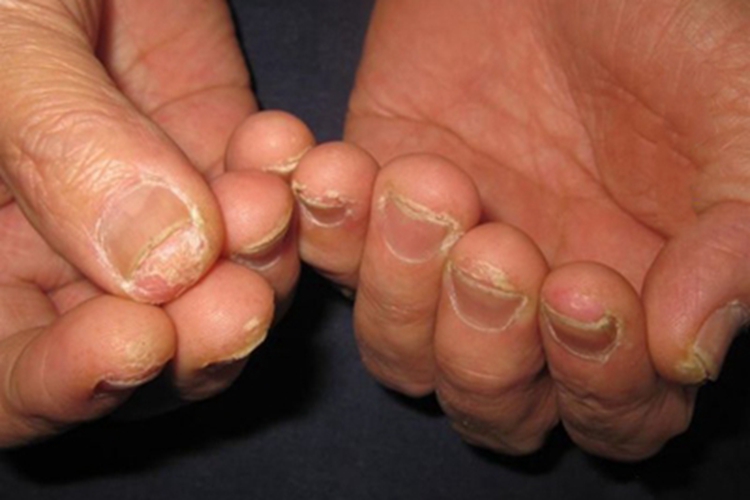 脆甲症手指甲变薄变短图