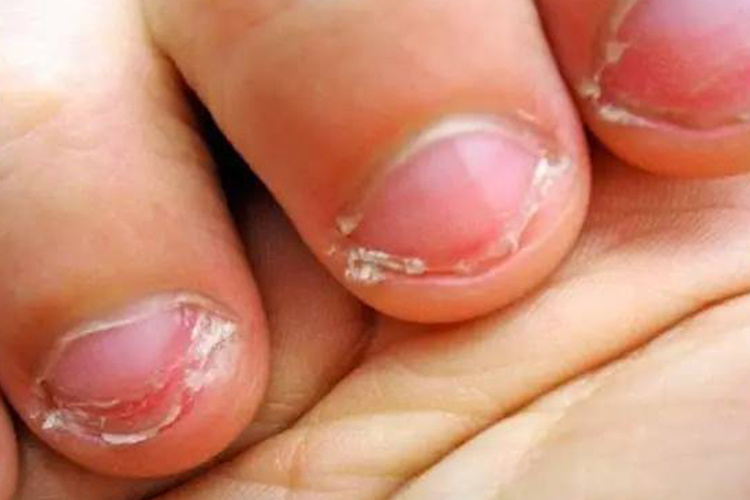 指甲畸形甲板缩短图