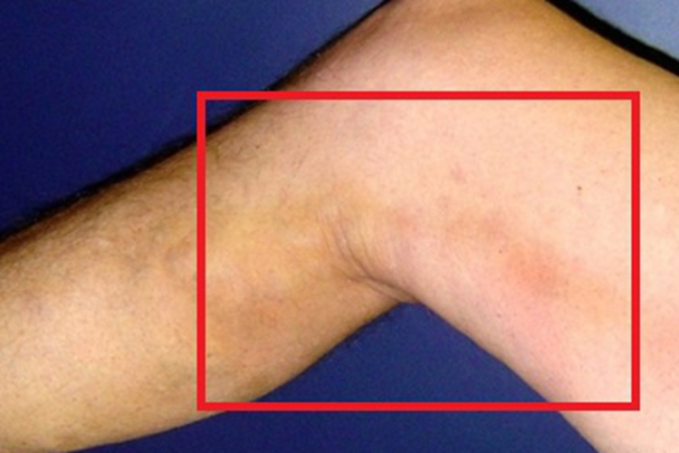 四肢血栓性浅静脉炎大腿症状图