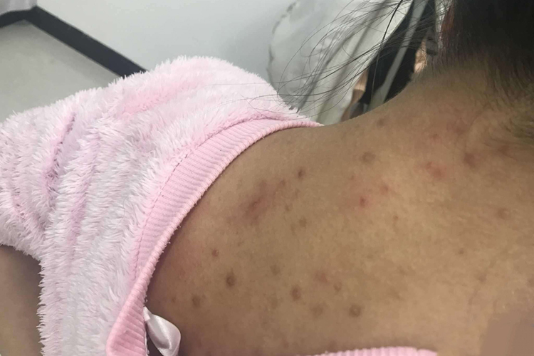 背部痤疮色素沉着图
