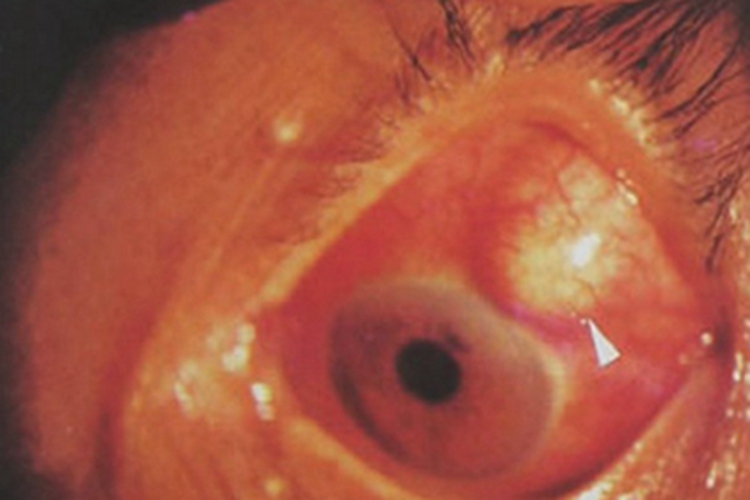 坏死性前巩膜炎症状图 坏死性前巩膜炎症状图