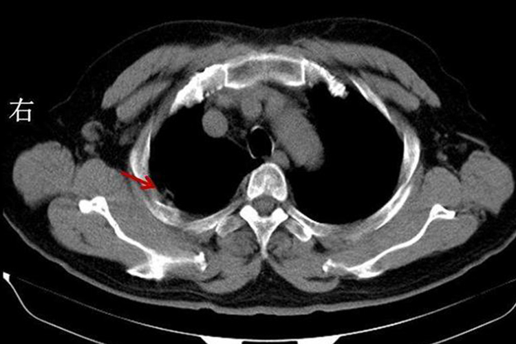 干性胸膜炎CT图