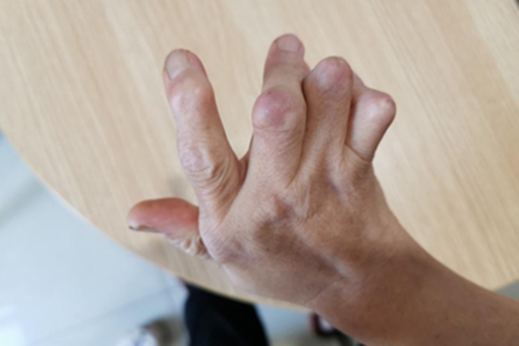 类风湿关节炎手指畸形图