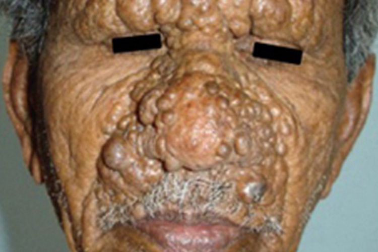 多发性毛发上皮瘤大疙瘩图 多发性毛发上皮瘤大疙瘩图