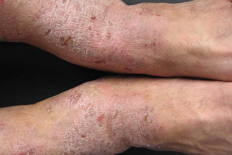 慢性湿疹苔癣样变图