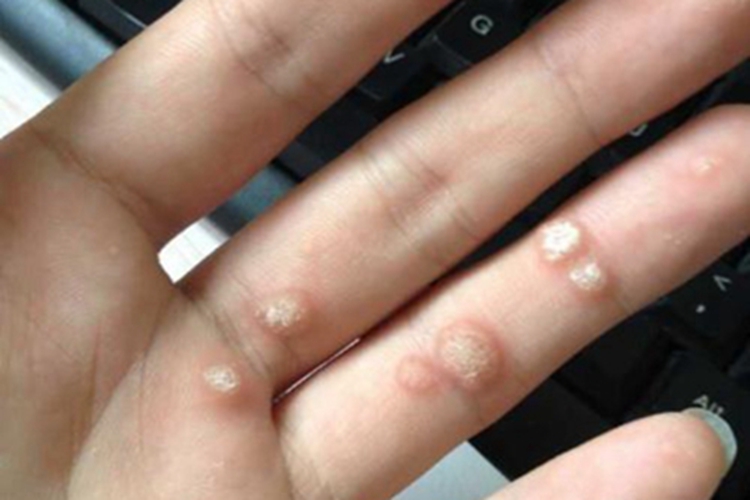 寻常疣样职业性疣赘小疙瘩图