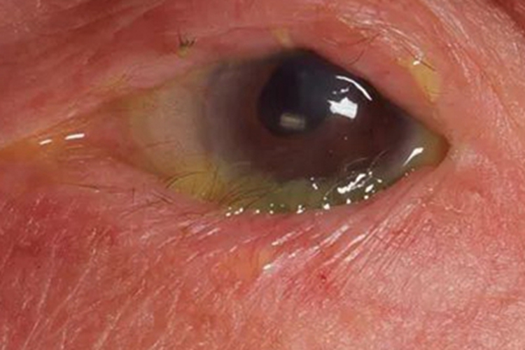 咽结膜热红肿图