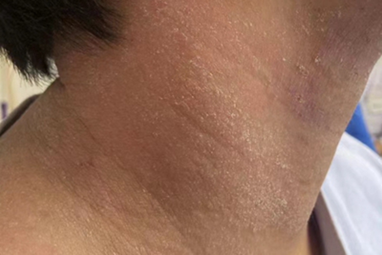 青年成人期特应性皮炎颈部鳞屑图 青年成人期特应性皮炎颈部鳞屑图