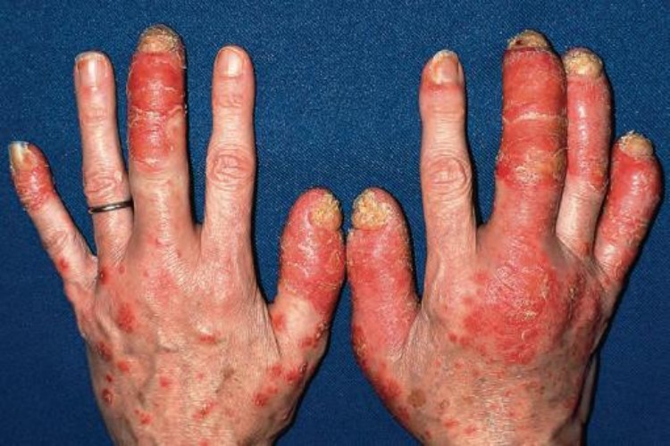 银屑病关节炎手部肿图 银屑病关节炎手部肿图