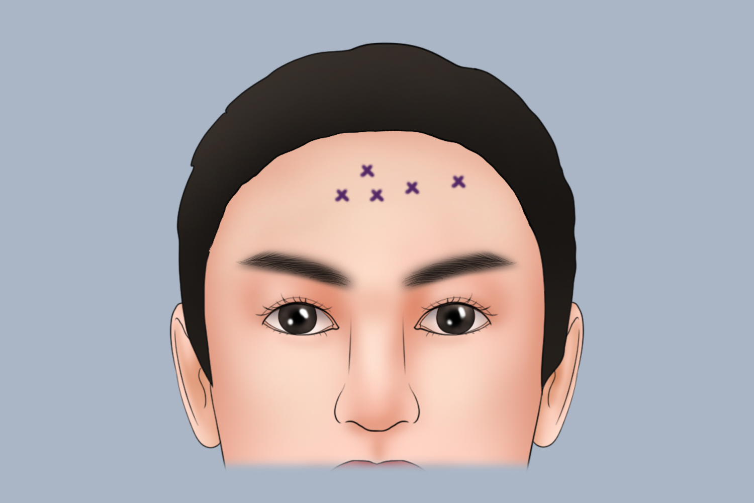 抬头纹除皱注射点位图