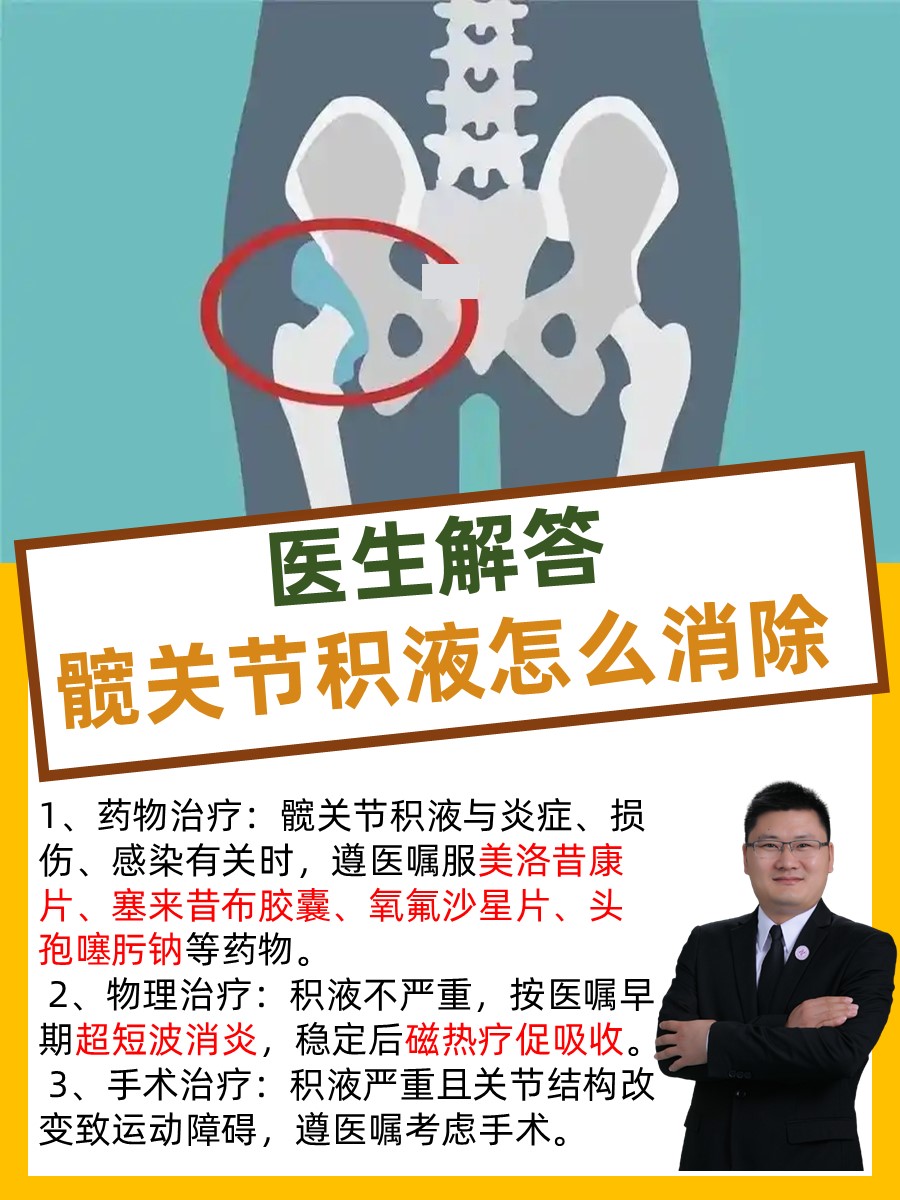 医生解答：髋关节积液怎么消除