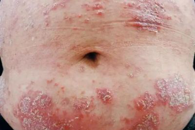IgA天疱疮腹部红斑图