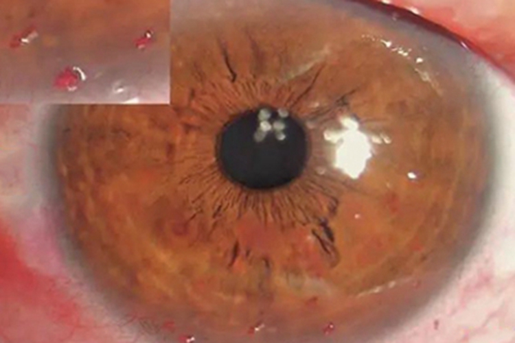 丝状角膜炎小红疙瘩图 丝状角膜炎小红疙瘩图