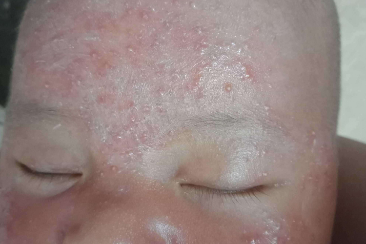 新生儿脸上热疹图 新生儿脸上热疹图