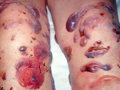 寻常型天疱疮腿上有许多紫色大水疱图.jpg