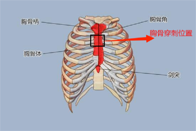 儿童胸骨骨穿位置图